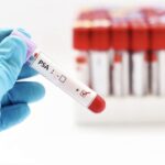 PSA test