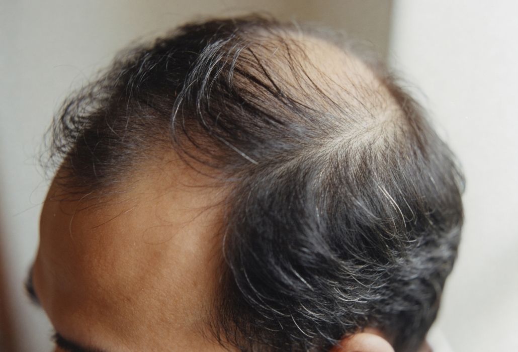 Perte cheveux homme : quelles options réalistes en 2026 ?